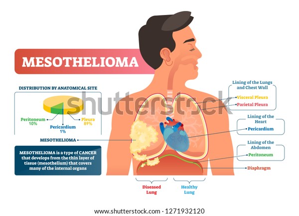 Mesothelioma vector illustration. Labeled lung\
cancer educational scheme. Diagram with diseased lung structure and\
compared with healthy side. Asbestos illness with peritoneum,\
pericardium and\
pleura.