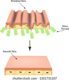 Mesotherapy Threads Lifting. threads for facelift. The structure of the skin. Wrinkles. Infographics. Vector illustration on isolated background.