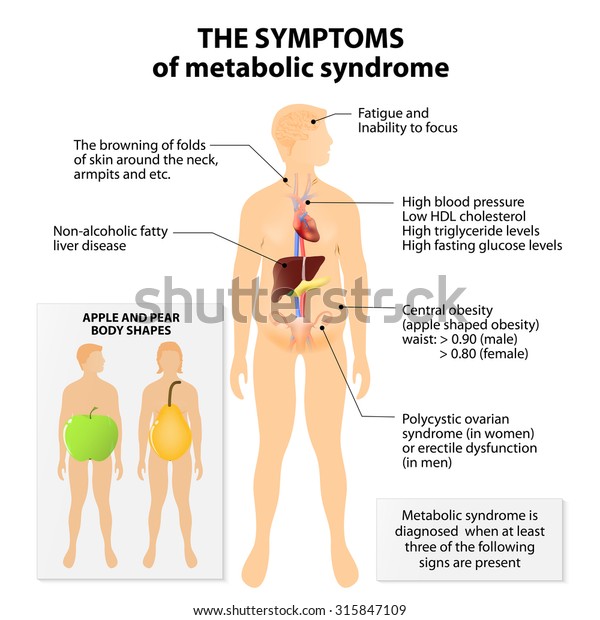 Metabolic syndrome. Signs and symptoms. Apple\
and pear body shapes. Metabolic syndrome is also known as metabolic\
syndrome X, cardiometabolic syndrome, syndrome X, insulin\
resistance syndrome