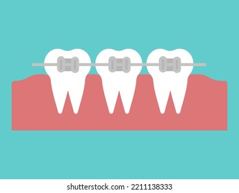 Metal braces dental orthodontic Teeth with braces. Alignment of bite of teeth, dental row with braces, Dental braces. Vector illustration