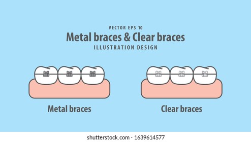 Metal braces teeth & Clear braces teeth illustration vector on blue background. Dental concept.