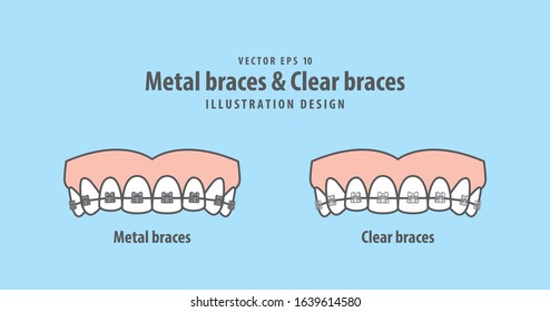 Metal braces teeth & Clear braces teeth (Upper) illustration vector on blue background. Dental concept.