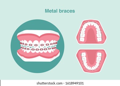 Metal braces with teeth model isolated on blue background,vector illustration