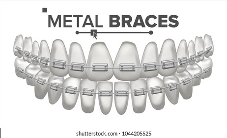 Metal Braces Vector. Human Jaw. Braces On Teeth. Smile With Braces. 3D Realistic Isolated Illustration
