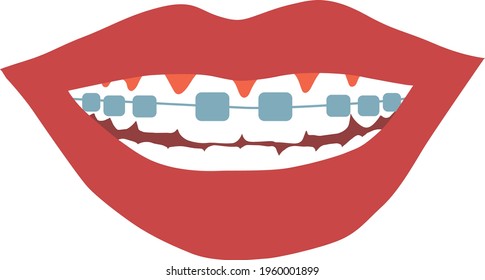 Metal dental Braces. Hand drawn flat vector illustration with dental braces. Smile with braces. Isolated on white background.