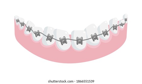 Metal dental braces on crooked teeth in jaw gum isolated