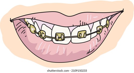Metal Dental Braces. Types of Dental Braces. Vector flat illustration of smile with braces on the teeth. 