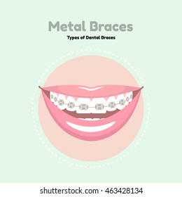 Metal Dental Braces. Types of Dental Braces. Vector flat illustration of smile with braces on the teeth. 