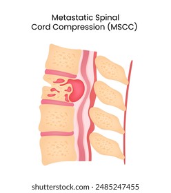 Metastatic Spinal Cord Compression (MSCC)