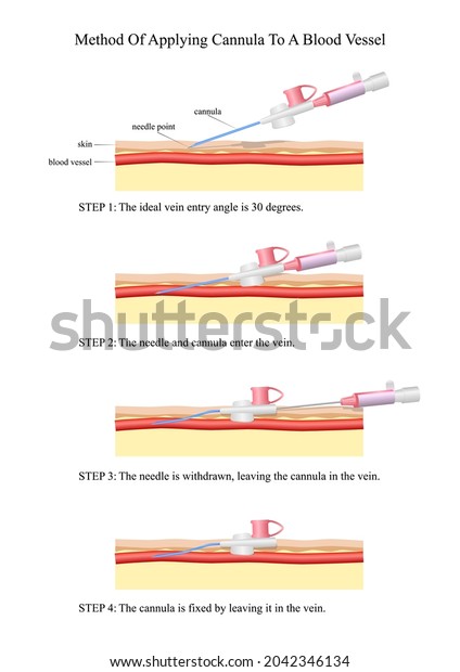 Method Applying Cannula Blood Vessel Stock Vector (royalty Free 