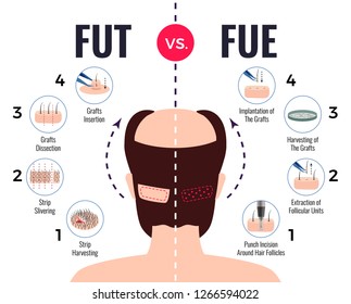 Methods Of Hair Transplantation Fut Vs Fue Poster With Infographic Elements On White Background Vector Illustration