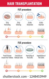 Methods of hair transplantation with stages of procedure infographics on white background vector illustration