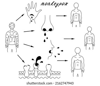 Methods Of Human Infection With Monkeypox. Diagram Of Human-to-human Transmission Of Smallpox. Sketch. In Contact With Body Fluids, Damaged Skin, Secretions From Pustules. Vector Illustration. 