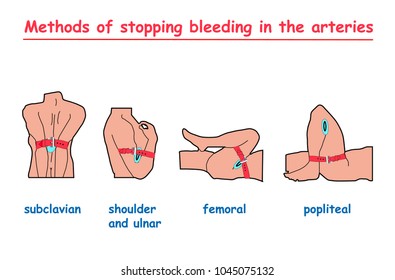 methods of stopping bleeding in the arteries. vector info graphic