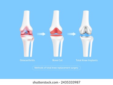 Métodos de cirugía o implante de reemplazo total de rodilla. Osteoporosis o artritis articular grave. Cartílago del hueso de la pierna. Tratamiento de tecnología médica de innovación. Vector.