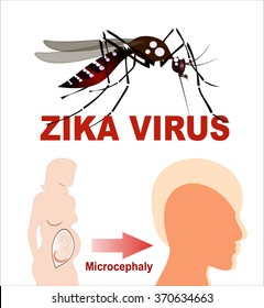 Microcephaly or Abnormal Smallness of the Head Concept. The Zika Fever Virus is linked to microcephaly birth defect cases from pregnant women bitten by Aedes aegypti mosquitoes. 