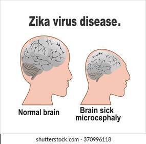 Microcephaly or Abnormal Smallness of the Head Concept. The Zika Fever Virus is linked to microcephaly birth defect cases from pregnant women bitten by Aedes aegypti mosquitoes.