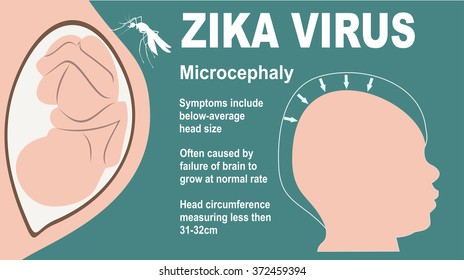 Microcephaly or Abnormal Smallness of the Head Concept. The Zika Fever Virus is linked to microcephaly birth defect cases from pregnant women bitten by Aedes aegypti mosquitoes.