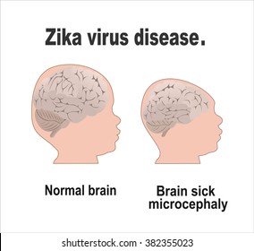 Microcephaly or Abnormal Smallness of the Head Concept. The Zika Fever Virus is linked to microcephaly birth defect cases from pregnant women bitten by Aedes aegypti mosquitoes.