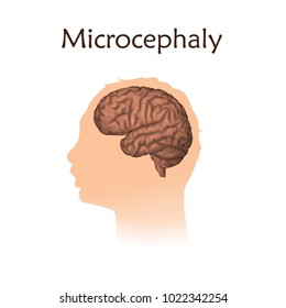 Microcephaly. White background. Silhouette of child head, brain.