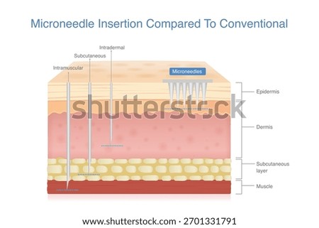 Microneedle insertion human skin layers compared to conventional with intramuscular, subcutaneous, and intradermal injection methods.
Illustration about skin maintain with medical derma technology.