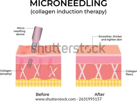 Microneedling Collagen Induction Therapy Diagram Design Vector Illustration