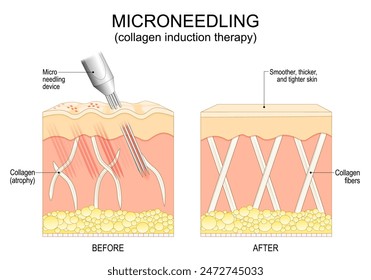 Microneedling procedure. Cross section of a human skin before and after collagen induction therapy. Skin rejuvenation. Anti-aging treatment. Surgical for remove wrinkles, scars, stretch, marks