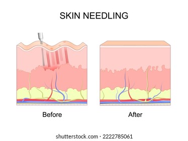 microneedling. skin needling. Before and after cosmetic procedure. Cross section of layers of a human skin with wrinkles. Close-up of Process of dermarolling. Collagen induction therapy. vector poster