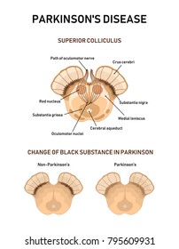 Midbrain Anatomy. Parkinson's Disease