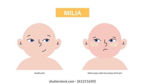 Milia on the newborn face and healthy child. Tiny white bumps caused by trapped keratin under the baby skin. Infant dermis problems, flat vector illustration for dermatology, skincare and pediatric