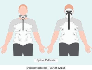 Milwaukee brace or TLSO is a rigid spinal Orthosis that spans the thoracic, lumbar and sacral spine. It is used to provide post-traumatic and post-surgical stabilization.Medical equipment, vector