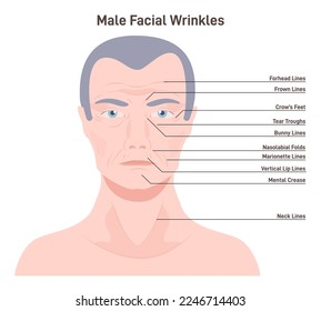Mimic wrinkles. Age-related skin changes. Aging process, forehead, under eye and mouth skin changes, man getting wrinkles with age. Flat vector illustration