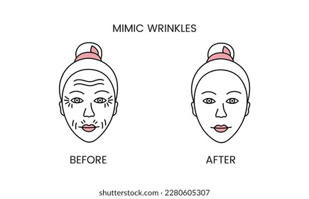 Mimic wrinkles, laser cosmetology before procedure and after applying treatment line icon in vector. Illustration of a woman with smooth clean skin and problematic skin.