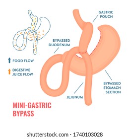 Mini Gastric Bypass. Bariatric Surgery Weight Loss Procedure. Stomach Reduction Anatomical Diagram Infographic. Health Care  Medical Concept. Vector Illustration.