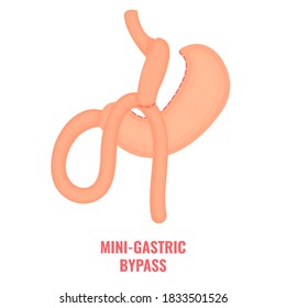 Mini gastric bypass. Bariatric surgery weight loss procedure. Stomach reduction anatomical diagram infographic. Health care  medical concept. Vector illustration.