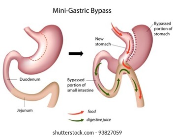 Mini Gastric Bypass Weight Loss Surgery