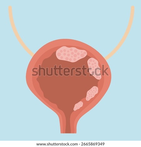 Minimalist bladder cancer vector icon illustration showing symptoms like blood in urine, pain, frequent urination, and similar diseases such as UTI, kidney stones, and bladder infection.