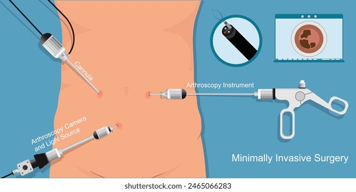 Minimally invasive surgery to access your organs through small portals, rather than large incisions. operations using minimally invasive methods.medical equipment or surgical tool,vector illustration.