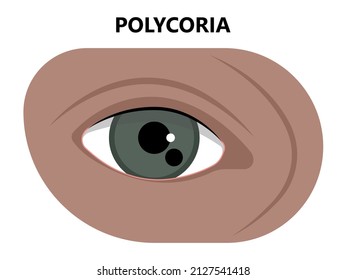 miosis eye pupil size iris retina brain Horner miotic muscle dilated ocular injury ptosis reflex Marcus Gunn defect optic nerve test palsy Trauma birth Adie tonic argyll hutchinson blind diplopia exam