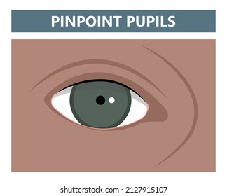 Pinpoint pupilas las anomalías del ojo 