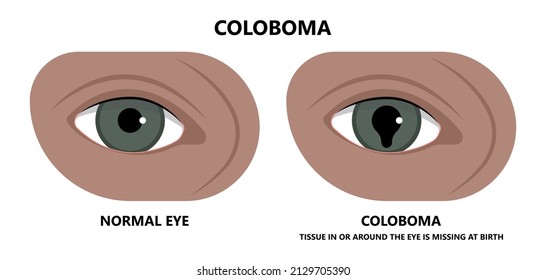 miosis eye pupil size iris retina brain Horner miotic muscle dilated ocular injury ptosis reflex Marcus Gunn defect optic nerve test palsy Trauma birth Adie tonic argyll hutchinson blind diplopia exam