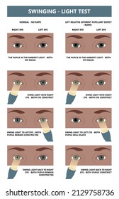 Miosis Eye Pupil Size Iris Retina Brain Horner Miotic Muscle Dilated Ocular Injury Ptosis Reflex Marcus Gunn Defect Optic Nerve Test Palsy Trauma Birth Adie Tonic Argyll Hutchinson Blind Diplopia Exam