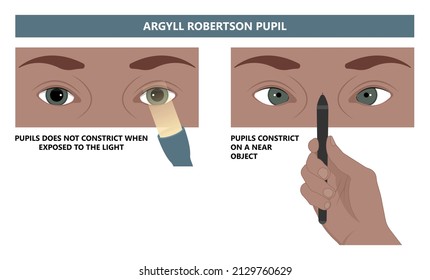 Miosis Eye Pupil Size Iris Retina Brain Horner Miotic Muscle Dilated Ocular Injury Ptosis Reflex Marcus Gunn Defect Optic Nerve Test Palsy Trauma Birth Adie Tonic Argyll Hutchinson Blind Diplopia Exam