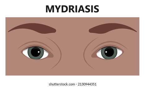 Midriasis de los alumnos dilatados cuando la luz es un trastorno de atenuación