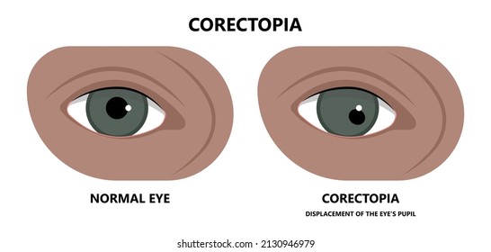 Miosis Eye Pupil Size Iris Retina Brain Horner Miotic Muscle Dilated Ocular Injury Ptosis Reflex Marcus Gunn Defect Optic Nerve Test Palsy Trauma Birth Adie Tonic Argyll Hutchinson Blind Diplopia Exam