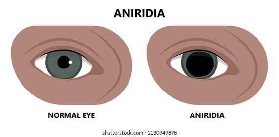 Miosis Eye Pupil Size Iris Retina Brain Horner Miotic Muscle Dilated Ocular Injury Ptosis Reflex Marcus Gunn Defect Optic Nerve Test Palsy Trauma Birth Adie Tonic Argyll Hutchinson Blind Diplopia Exam