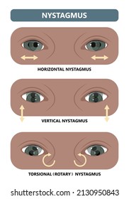 Miosis Eye Pupil Size Iris Retina Brain Horner Miotic Muscle Dilated Ocular Injury Ptosis Reflex Marcus Gunn Defect Optic Nerve Test Palsy Trauma Birth Adie Tonic Argyll Hutchinson Blind Diplopia Exam