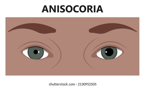 Miosis Eye Pupil Size Iris Retina Brain Horner Miotic Muscle Dilated Ocular Injury Ptosis Reflex Marcus Gunn Defect Optic Nerve Test Palsy Trauma Birth Adie Tonic Argyll Hutchinson Blind Diplopia Exam