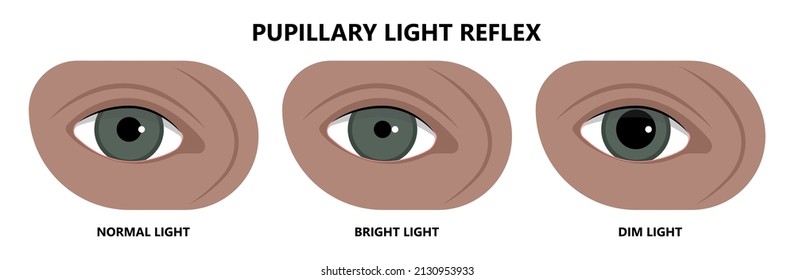 miosis eye pupil size iris retina brain Horner miotic muscle dilated ocular injury ptosis reflex Marcus Gunn defect optic nerve test palsy Trauma birth Adie tonic argyll hutchinson blind diplopia exam