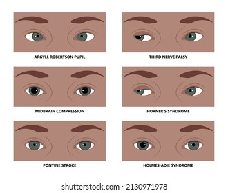 Miosis Eye Pupil Size Iris Retina Brain Horner Miotic Muscle Dilated Ocular Injury Ptosis Reflex Marcus Gunn Defect Optic Nerve Test Palsy Trauma Birth Adie Tonic Argyll Hutchinson Blind Diplopia Exam